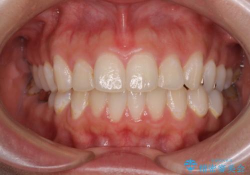 出っ歯と奥歯のむし歯 ワイヤー装置での抜歯矯正とセラミック治療の症例 治療前