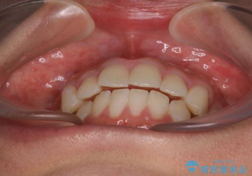 出っ歯と奥歯のむし歯 ワイヤー装置での抜歯矯正とセラミック治療の治療前