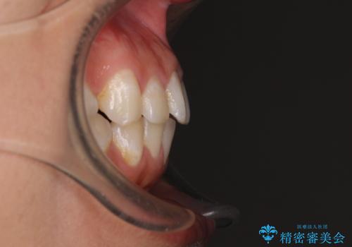 出っ歯と奥歯のむし歯 ワイヤー装置での抜歯矯正とセラミック治療の治療前