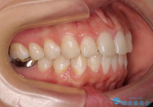 出っ歯と奥歯のむし歯 ワイヤー装置での抜歯矯正とセラミック治療の治療前