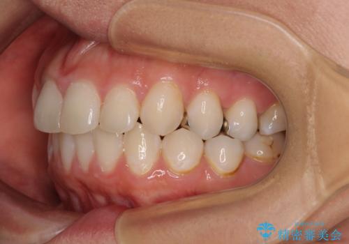 出っ歯と奥歯のむし歯 ワイヤー装置での抜歯矯正とセラミック治療の治療前