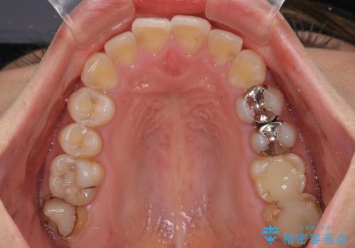 出っ歯と奥歯のむし歯 ワイヤー装置での抜歯矯正とセラミック治療の治療前