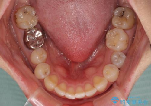 出っ歯と奥歯のむし歯 ワイヤー装置での抜歯矯正とセラミック治療の治療前