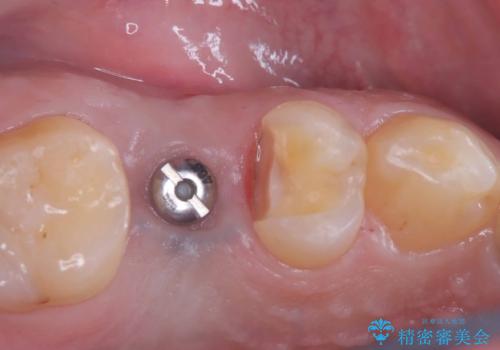 低侵襲なインプラント|痛くないインプラント|エンドペリオ病変|虫歯治療|セラッミクインレーの治療中