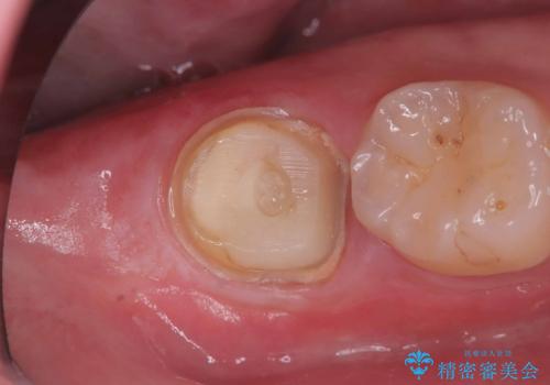 銀歯を白くしたい|オールセラミッククラウンの治療中