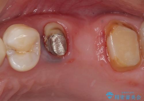 以前の治療箇所が痛む 全顎的なむし歯治療の治療前