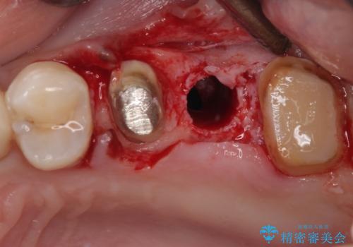 以前の治療箇所が痛む 全顎的なむし歯治療の治療中