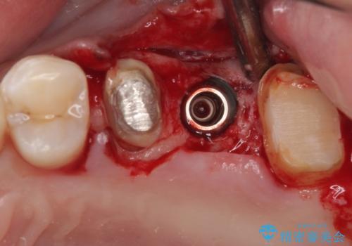 以前の治療箇所が痛む 全顎的なむし歯治療の治療後