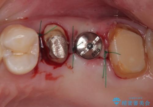 以前の治療箇所が痛む 全顎的なむし歯治療の治療中