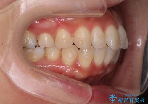 [ マウスピース矯正治療 ] がたつき　ねじれのある前歯をきれいにしたいの治療中