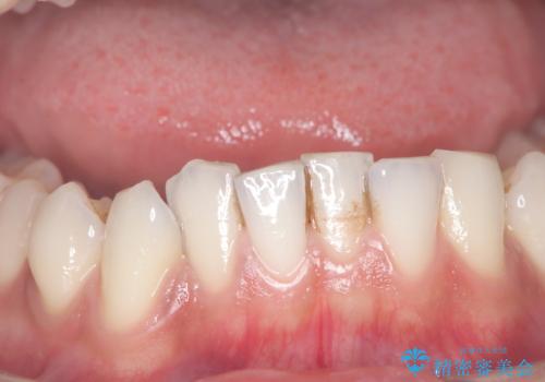 歯の着色にはエアーフローの症例 治療前