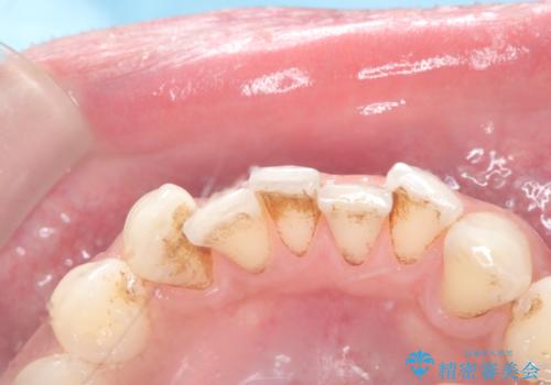 歯の着色にはエアーフローの治療前