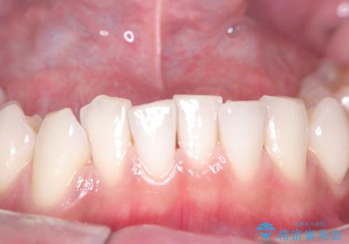 歯の着色にはエアーフローの症例 治療後