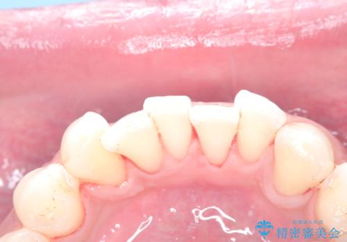 歯の着色にはエアーフローの治療後