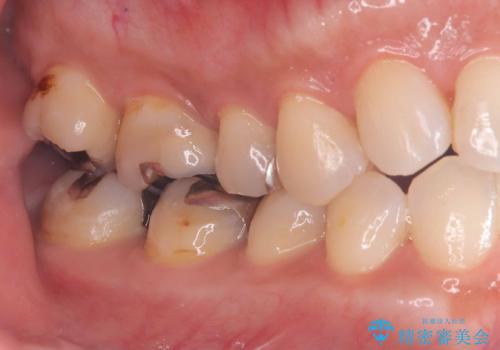 銀歯の下の虫歯|オールセラミッククラウン|歯を長持ちさせるための治療|歯の神経を守るの治療前