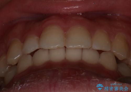 【インビザラインモニター】前歯のがたつき気になるの治療後