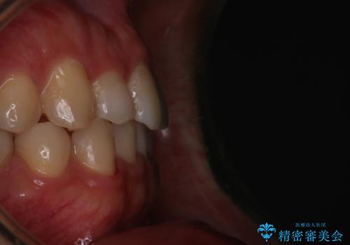 【インビザラインモニター】前歯のがたつき気になるの治療後