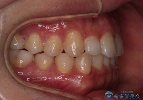 【インビザラインモニター】前歯のがたつき気になるの治療後