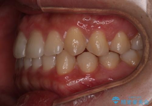 【インビザラインモニター】前歯のがたつき気になるの治療後