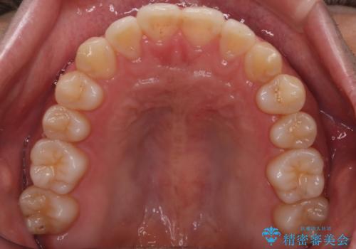 【インビザラインモニター】前歯のがたつき気になるの治療後