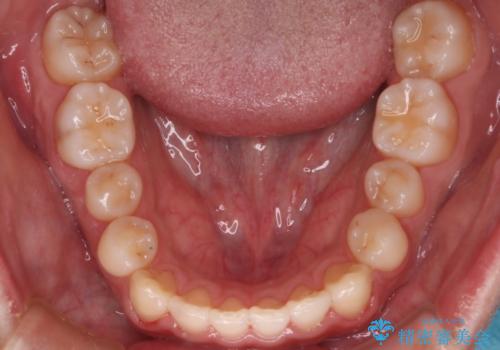 【インビザラインモニター】前歯のがたつき気になるの治療後