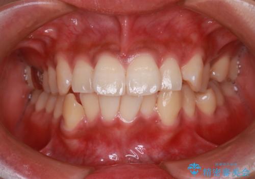 前歯の前突と口元の突出感を改善|上下左右4番抜歯+審美ワイヤー矯正の治療前