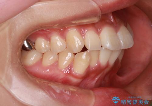 前歯の前突と口元の突出感を改善|上下左右4番抜歯+審美ワイヤー矯正の治療前