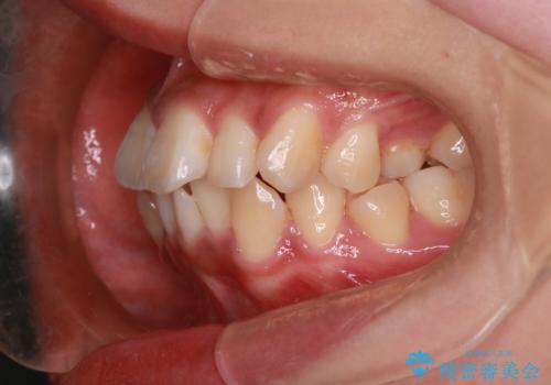 前歯の前突と口元の突出感を改善|上下左右4番抜歯+審美ワイヤー矯正の治療前