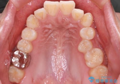 前歯の前突と口元の突出感を改善|上下左右4番抜歯+審美ワイヤー矯正の治療前