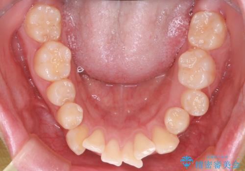 前歯の前突と口元の突出感を改善|上下左右4番抜歯+審美ワイヤー矯正の治療前