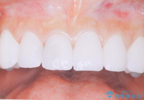 メンテナンスで10年後のセラミックの症例 治療前