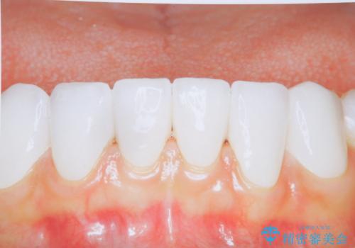 メンテナンスで10年後のセラミックの治療前