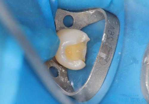 セラッミクインレー|オールセラミッククラウン|銀歯による二次カリエス|ラバーダムシート使用の治療中