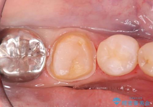 セラッミクインレー|オールセラミッククラウン|銀歯による二次カリエス|ラバーダムシート使用の治療中