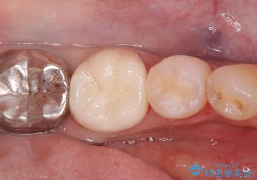 セラッミクインレー|オールセラミッククラウン|銀歯による二次カリエス|ラバーダムシート使用の治療後