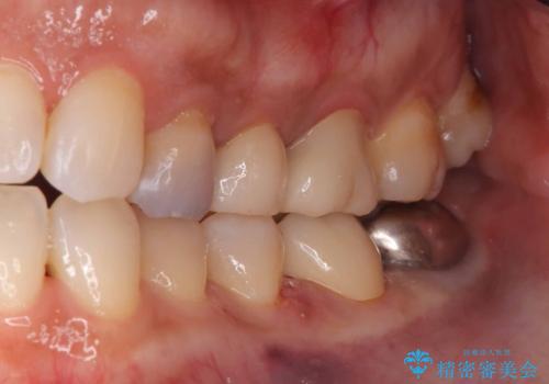 セラッミクインレー|オールセラミッククラウン|銀歯による二次カリエス|ラバーダムシート使用の治療後