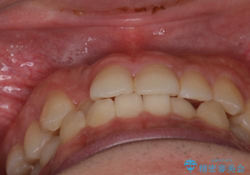 【インビザラインモニター】前歯のがたつき気になるの治療前