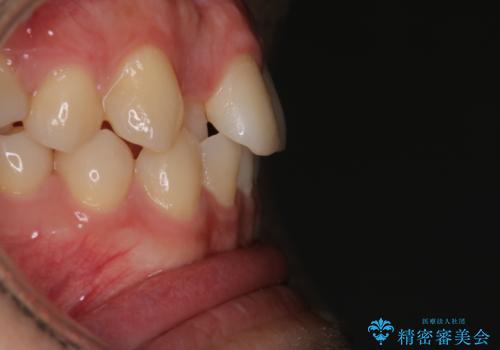 【インビザラインモニター】前歯のがたつき気になるの治療前