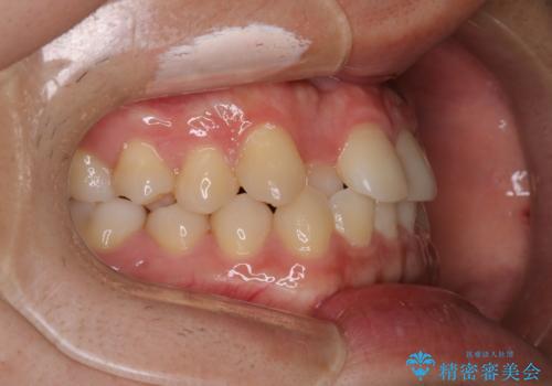 【インビザラインモニター】前歯のがたつき気になるの治療前