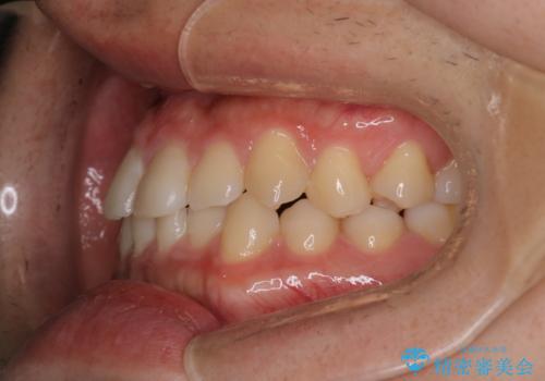 【インビザラインモニター】前歯のがたつき気になるの治療前