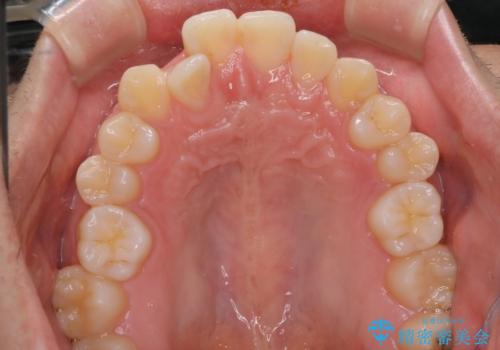 【インビザラインモニター】前歯のがたつき気になるの治療前