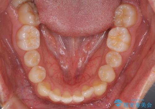 【インビザラインモニター】前歯のがたつき気になるの治療前