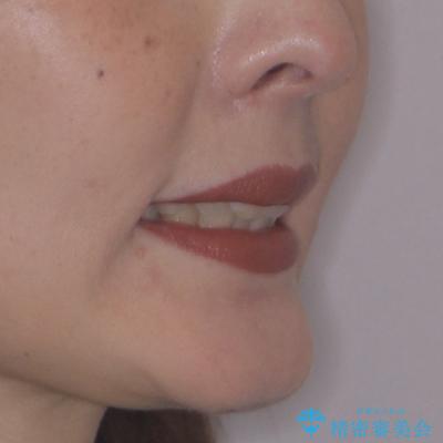 飛び出した前歯 抜歯矯正で横顔が劇的変化の治療後(顔貌)