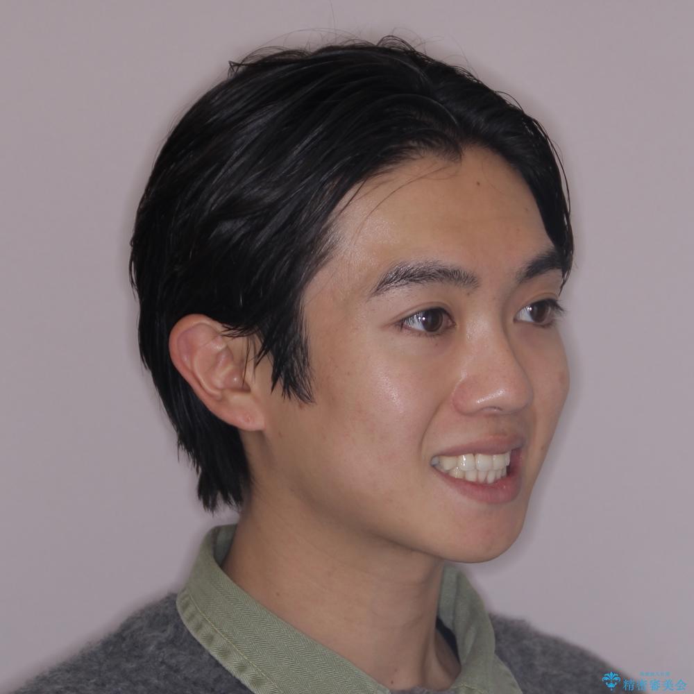 【モニター】デコボコ前歯をワイヤー装置での抜歯矯正で改善の治療後(顔貌)