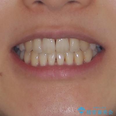 八重歯を改善 ワイヤー装置での抜歯矯正の治療後(顔貌)