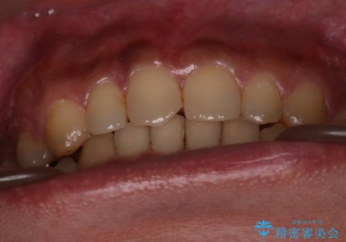 【モニター】インビザライン 前歯の捻れを治したいの治療後