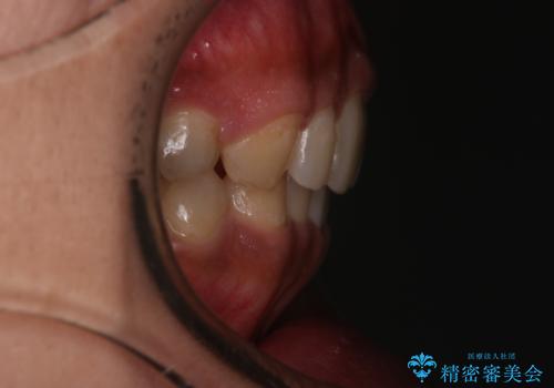 【モニター】インビザライン 前歯の捻れを治したいの治療後