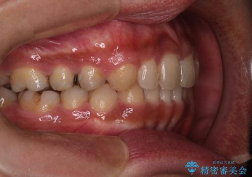 【モニター】インビザライン 前歯の捻れを治したいの治療後