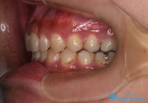 【モニター】インビザライン 前歯の捻れを治したいの治療後