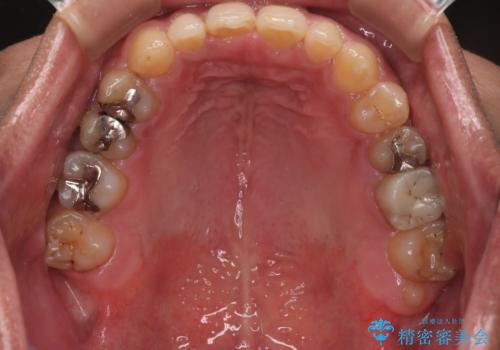 【モニター】インビザライン 前歯の捻れを治したいの治療後